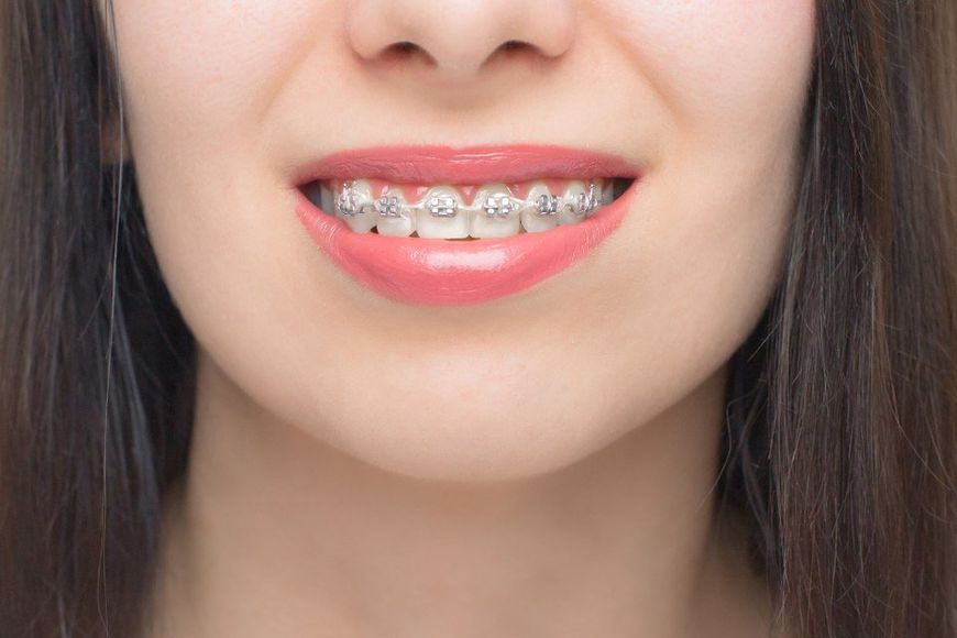 girl with braces