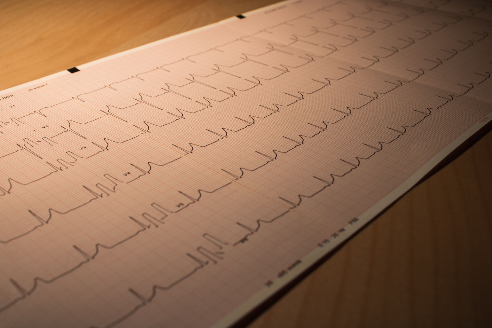 Deciphering EKG Results: Understanding Lines and Waves