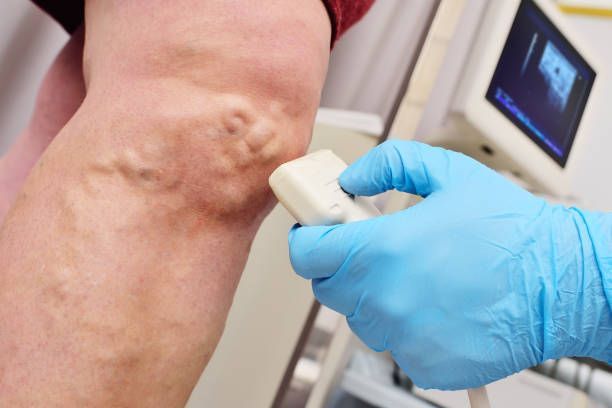 A medical professional using an ultrasound probe on a leg with visible varicose veins.