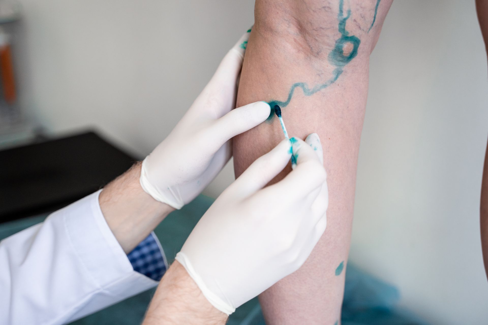 Medical professional applying treatment to a leg with marked veins; blue ink and latex gloves visible. Medical professional applying treatment to a leg with marked veins; blue ink and latex gloves visible.