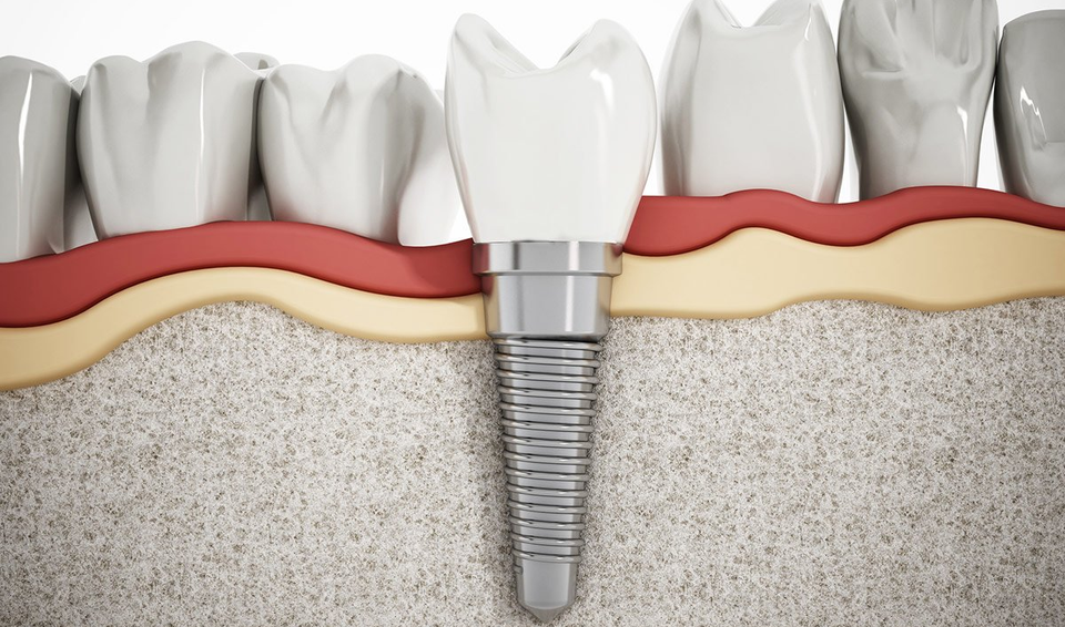 The Lifespan Of Dental Implants