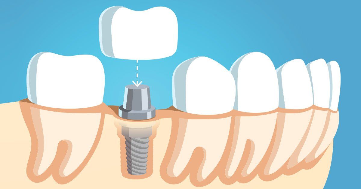 What Are Dental Crowns and How Are They Used?