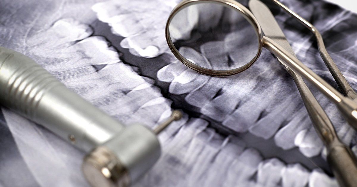 What Are Dental Xrays? A Complete Guide