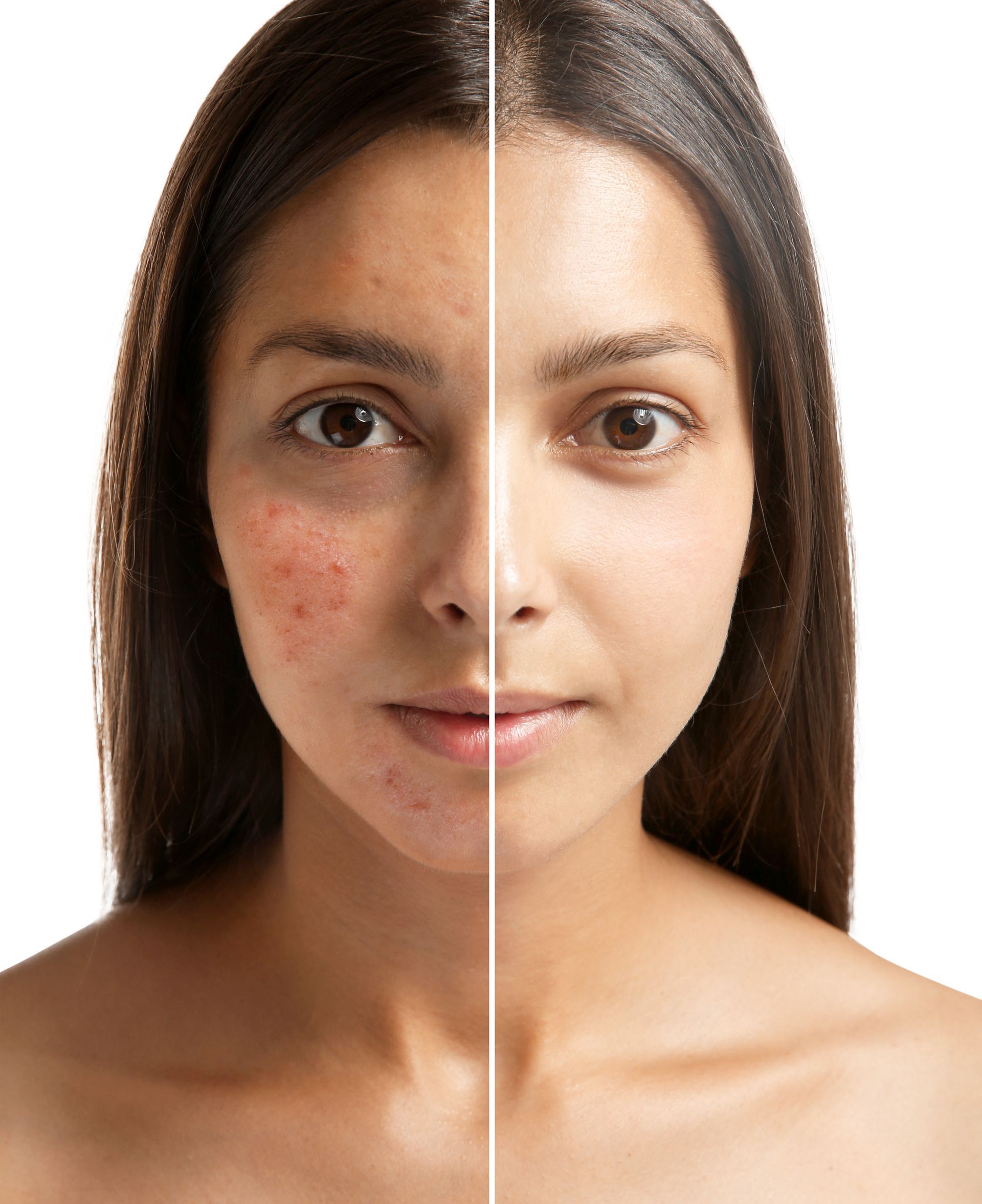 A split-screen comparison showing a face with skin redness and blemishes on the left and clear, even skin on the right.