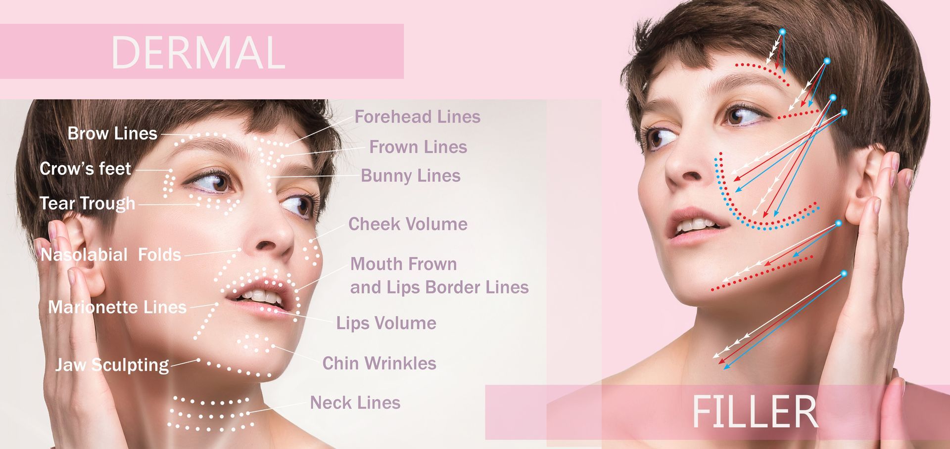 Two women with facial mapping lines illustrating dermal filler treatment areas on face and neck.