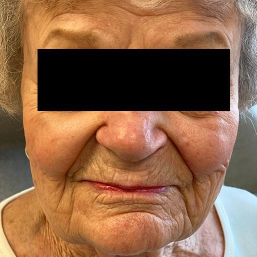 real patient before and after reconstructive surgery after mohs in phoenix arizona