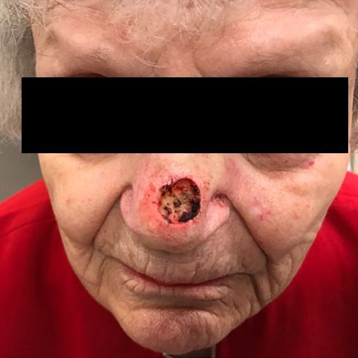 Mohs Surgery - Case 1 before