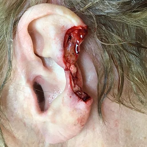 Mohs Surgery - Case 10 before