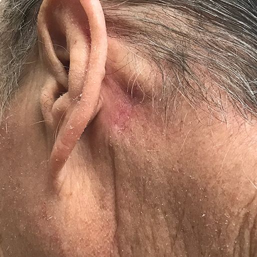 Mohs Surgery - Case 11 After
