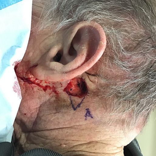 Mohs Surgery - Case 11 before