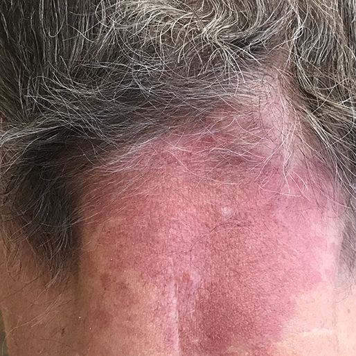 Mohs Surgery - Case 12 After