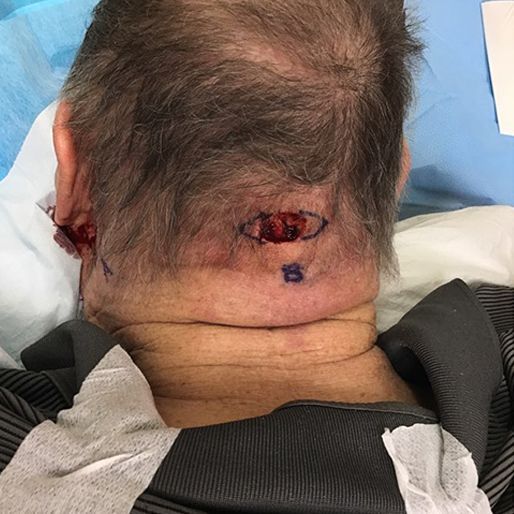 Mohs Surgery - Case 12 before