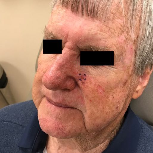 Mohs Surgery - Case 13 After