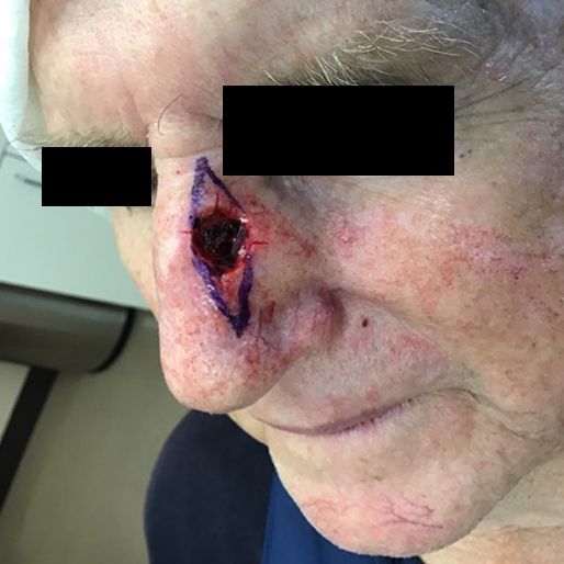 Mohs Surgery - Case 13 before