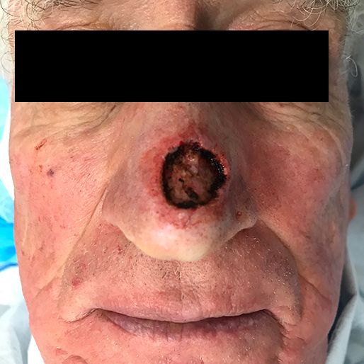 Mohs Surgery - Case 14 before