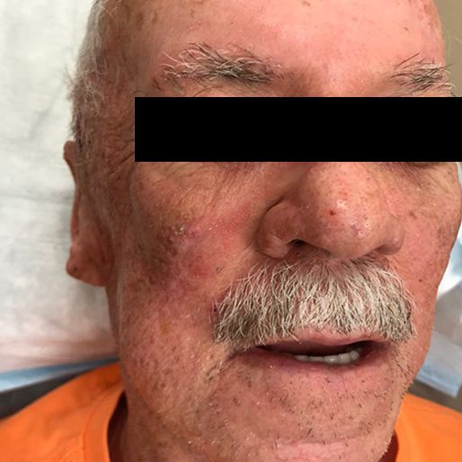 Mohs Surgery - Case 15 After