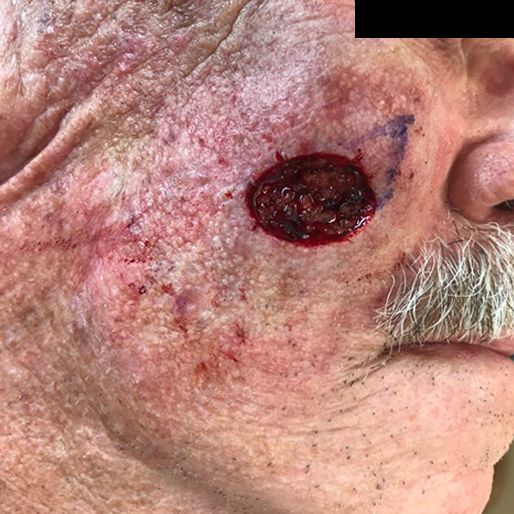 Mohs Surgery - Case 15 before