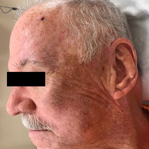 Mohs Surgery - Case 16 After