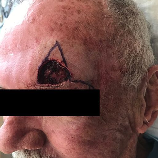 Mohs Surgery - Case 16 before