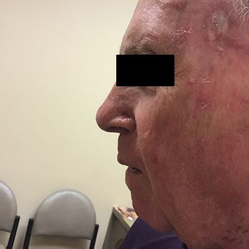 Mohs Surgery - Case 17 After