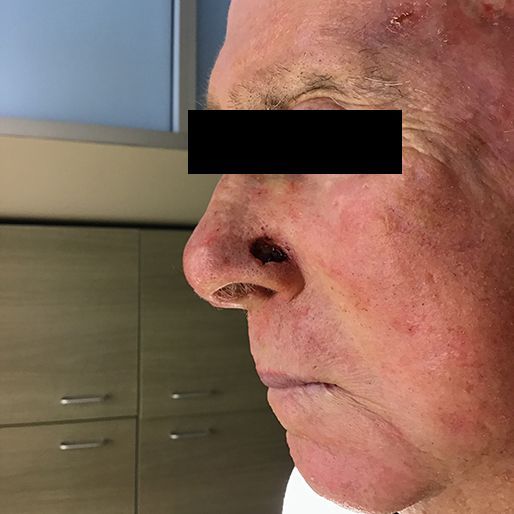 Mohs Surgery - Case 17 before