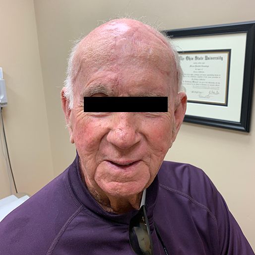 Mohs Surgery - Case 18 After