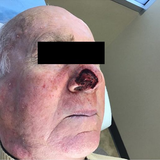 Mohs Surgery - Case 18 before