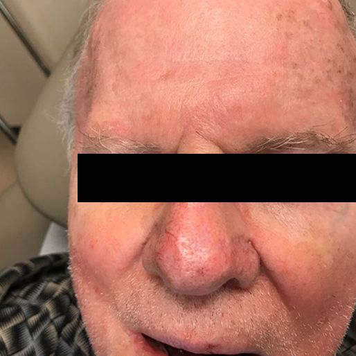 Mohs Surgery - Case 19 After