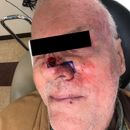 Mohs Surgery - Case 19 before