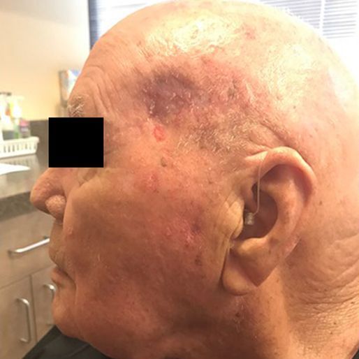 Mohs Surgery - Case 2 After