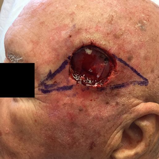 Mohs Surgery - Case 2 before