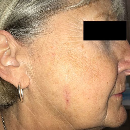 Mohs Surgery - Case 20 After