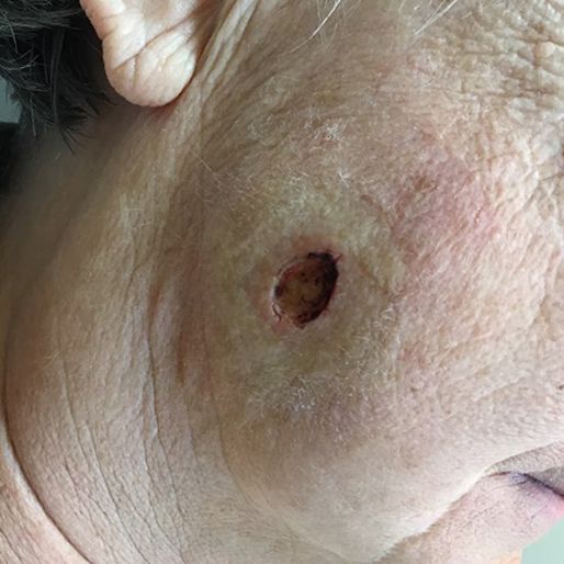 Mohs Surgery - Case 20 before
