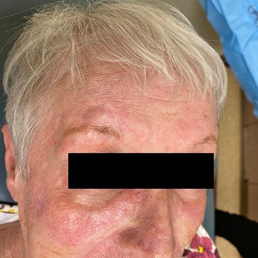 Mohs Surgery - Case 21 After