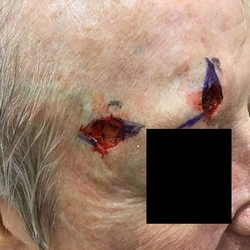 Mohs Surgery - Case 21 before