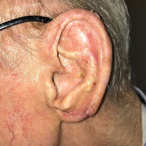 Mohs Surgery - Case 22 After