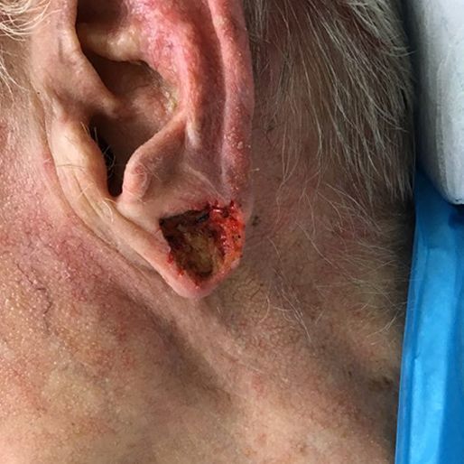 Mohs Surgery - Case 22 before