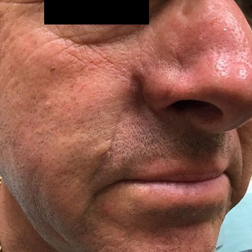 Mohs Surgery - Case 23 After