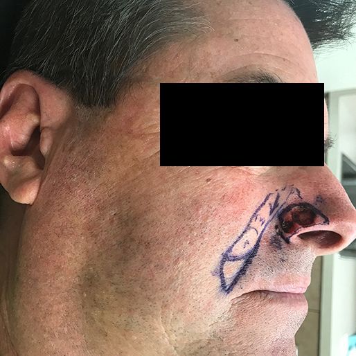 Mohs Surgery - Case 23 before