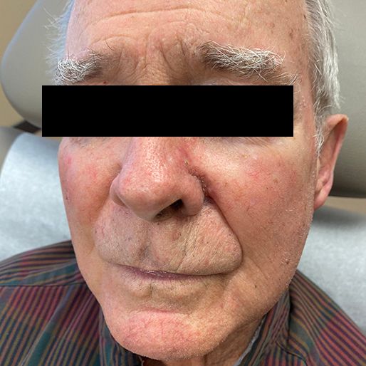 Mohs Surgery - Case 24 After