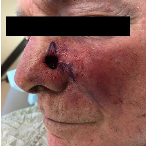 Mohs Surgery - Case 24 before