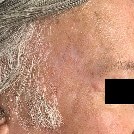 Mohs Surgery - Case 25 After