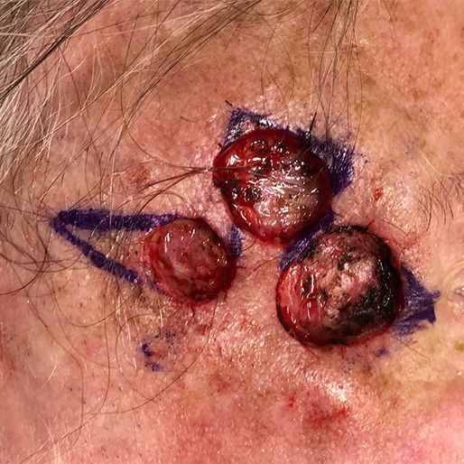 Mohs Surgery - Case 25 before