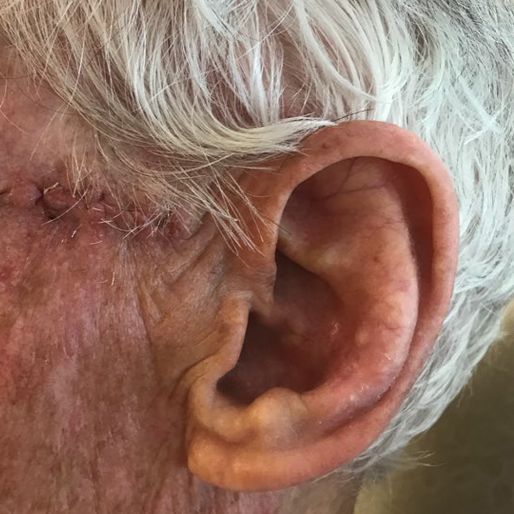 Mohs Surgery - Case 26 After