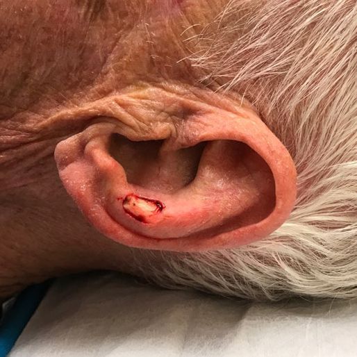 Mohs Surgery - Case 26 before