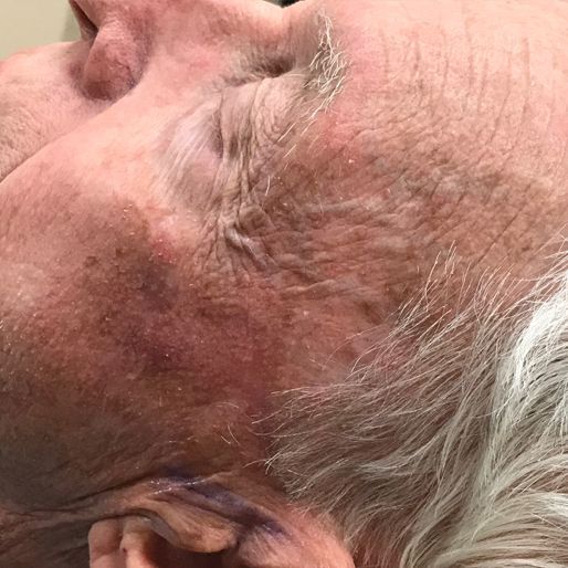 Mohs Surgery - Case 27 After