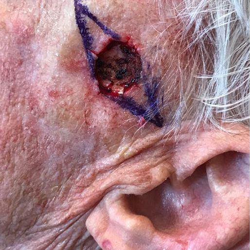Mohs Surgery - Case 27 before