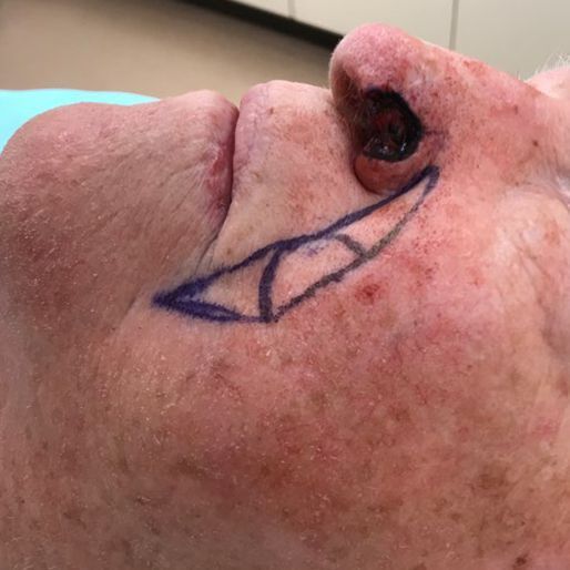 Mohs Surgery - Case 28 before