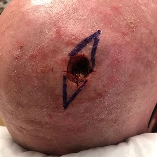 Mohs Surgery - Case 29 before
