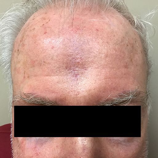 Mohs Surgery - Case 3 After